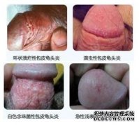 运城治龟头发炎费用